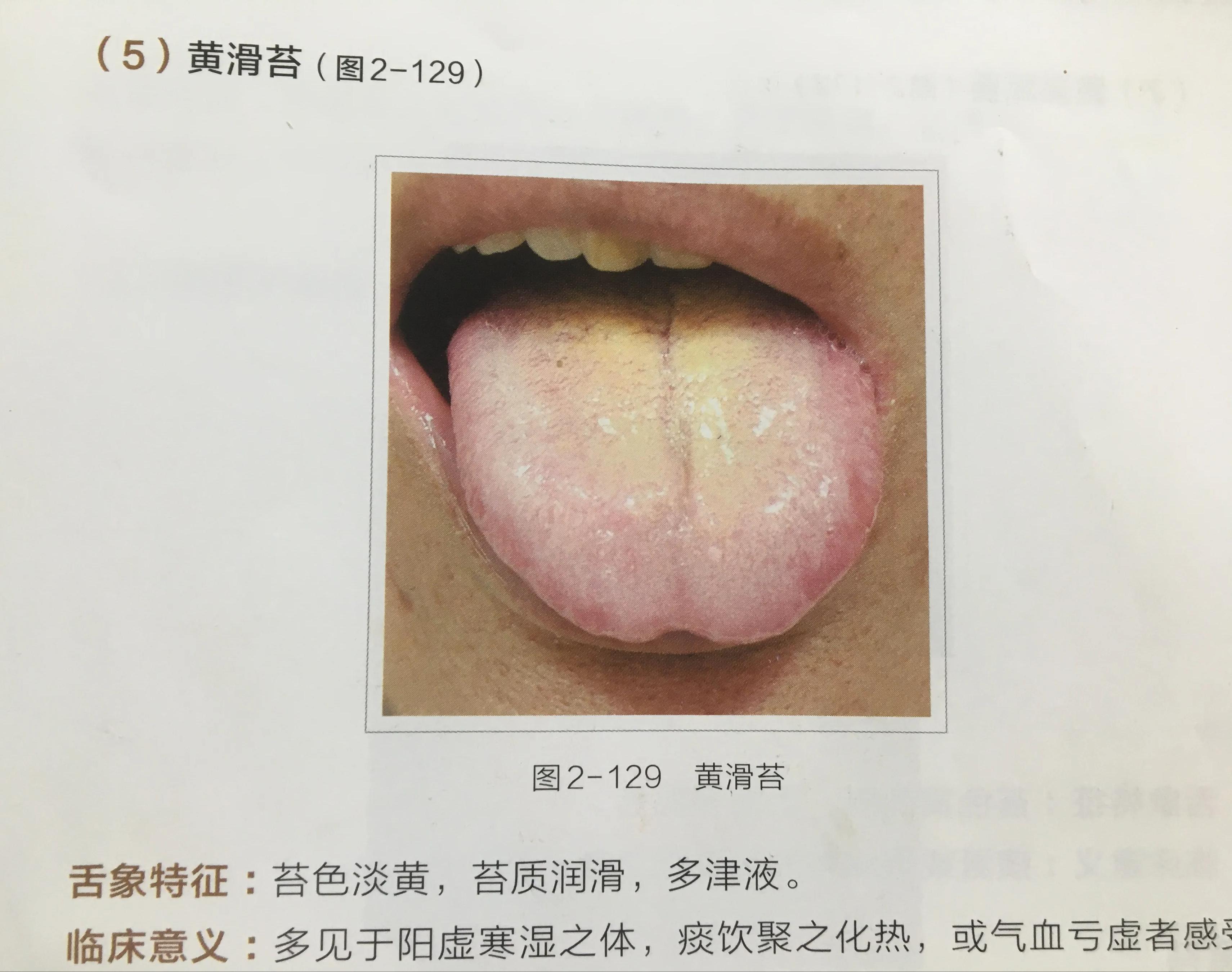 一个月婴儿舌苔发黄，原因、影响与处理方法