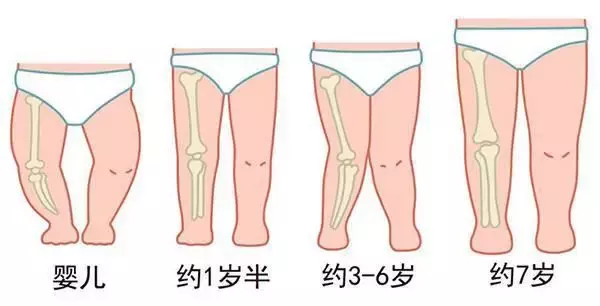 三个月宝宝腿不直，原因、观察与处理方法