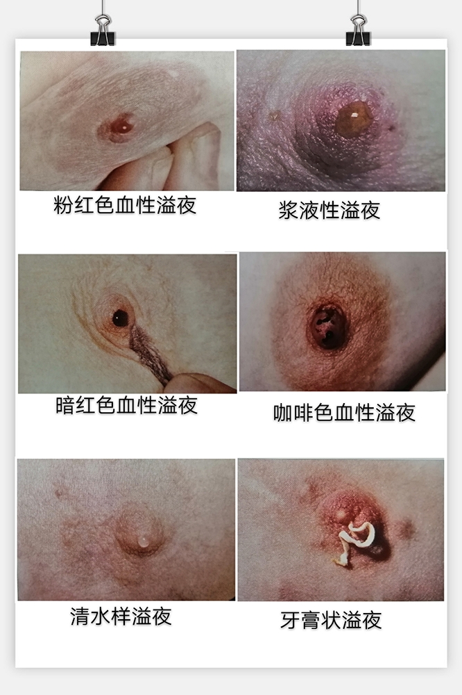 孕六个月乳头痒，原因、影响与应对措施